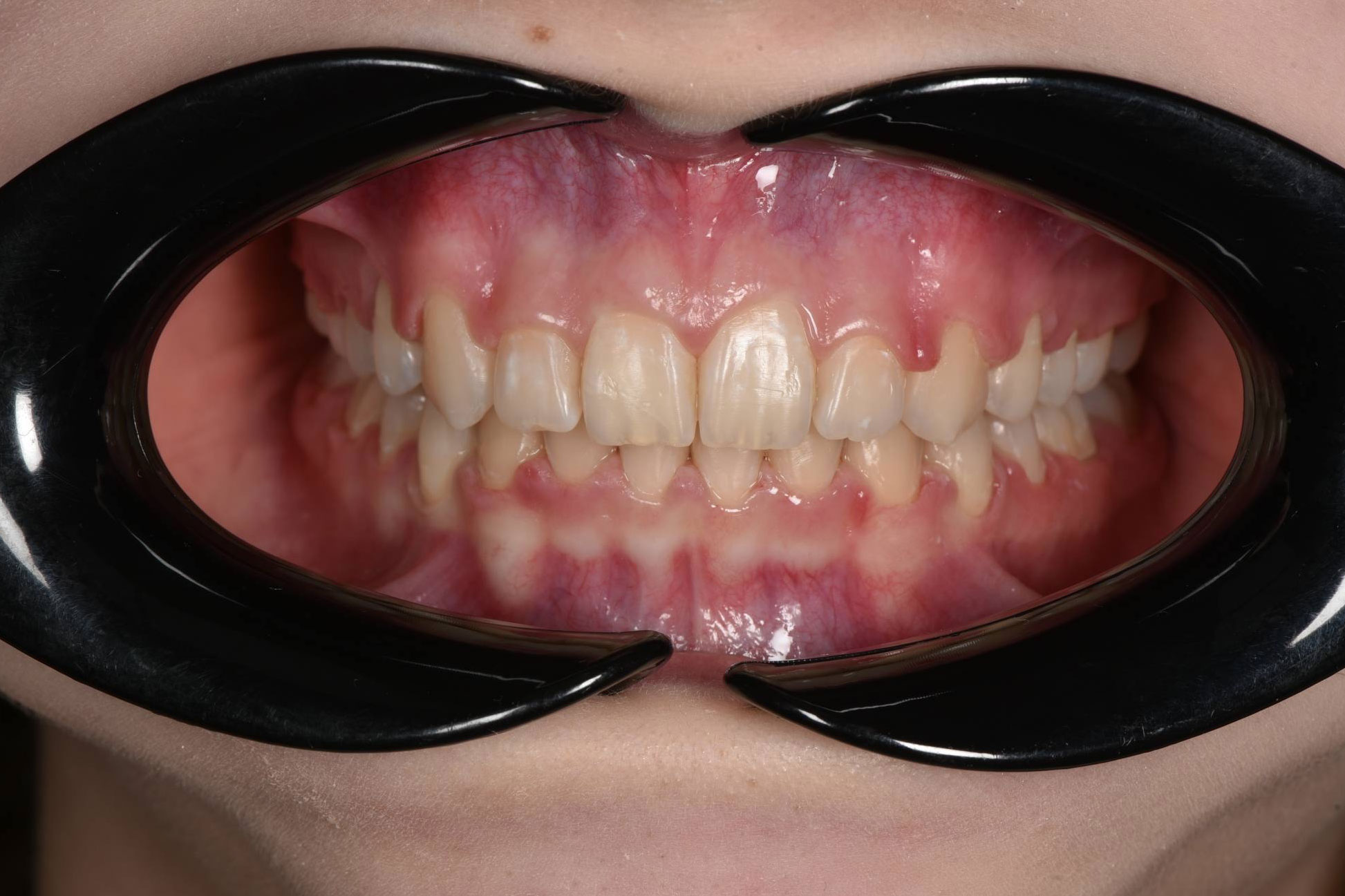 Коррекция дистального прикуса у подростка. Брекеты Damon. Врач: Ушакова А.Г.