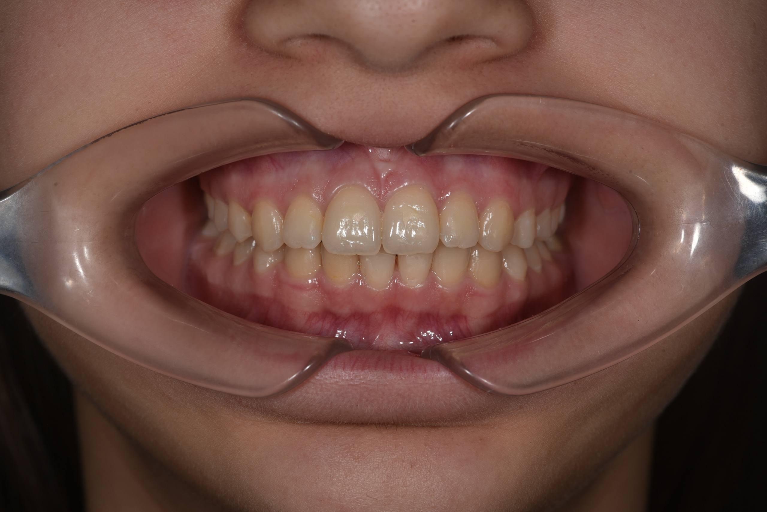 Коррекция центральной линии, дистального прикуса. Брекеты Biomim+ минивинт. Врач: Ушакова А.Г.