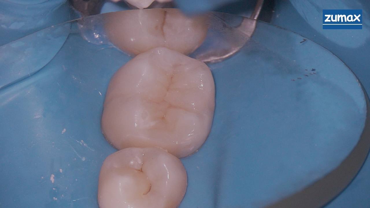 Лечение кисты зуба Фото До и После