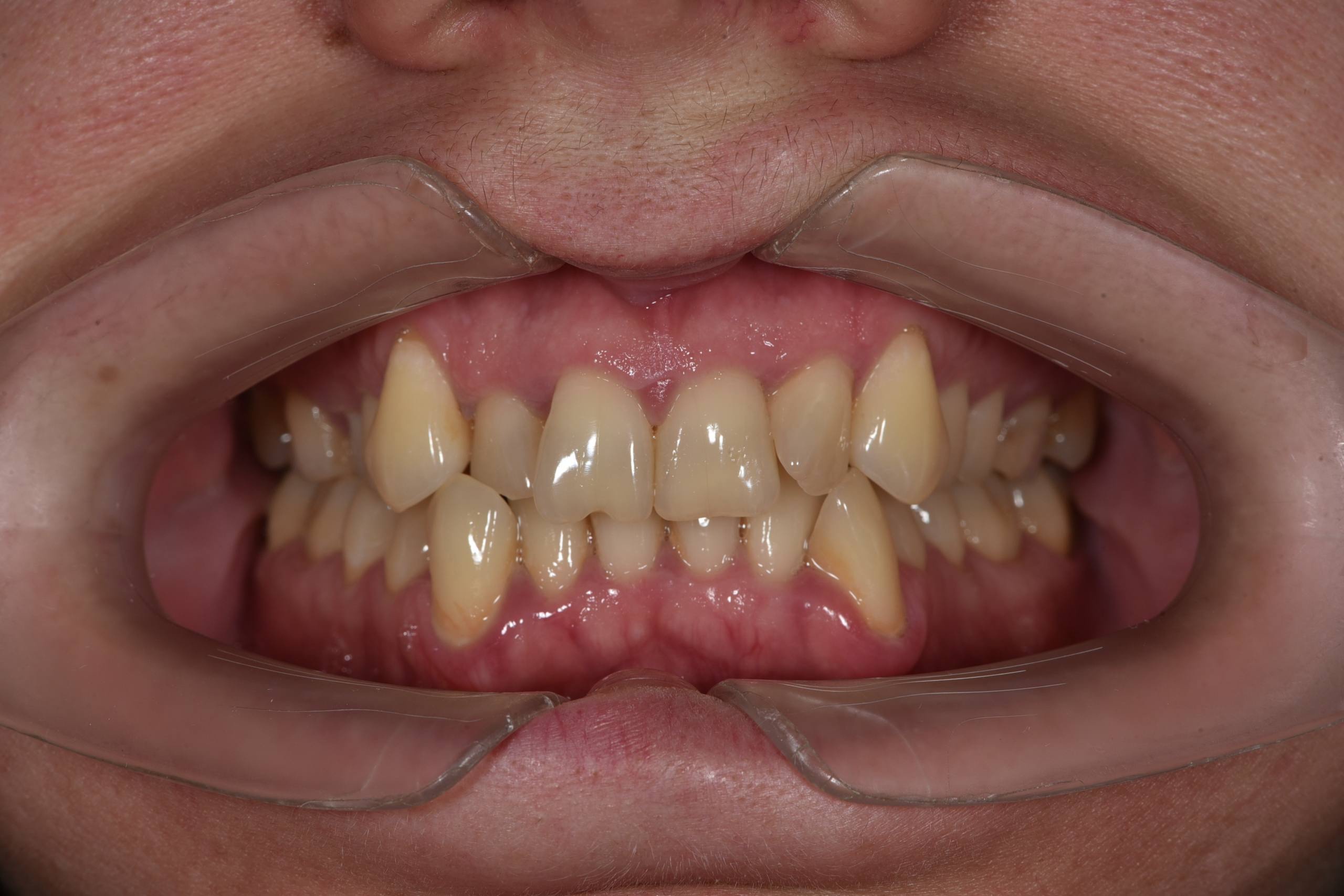 Коррекция скученного положения зубов на верхней и нижней челюсти. Брекеты Damon + минивинт. Врач: Ушакова А.Г.