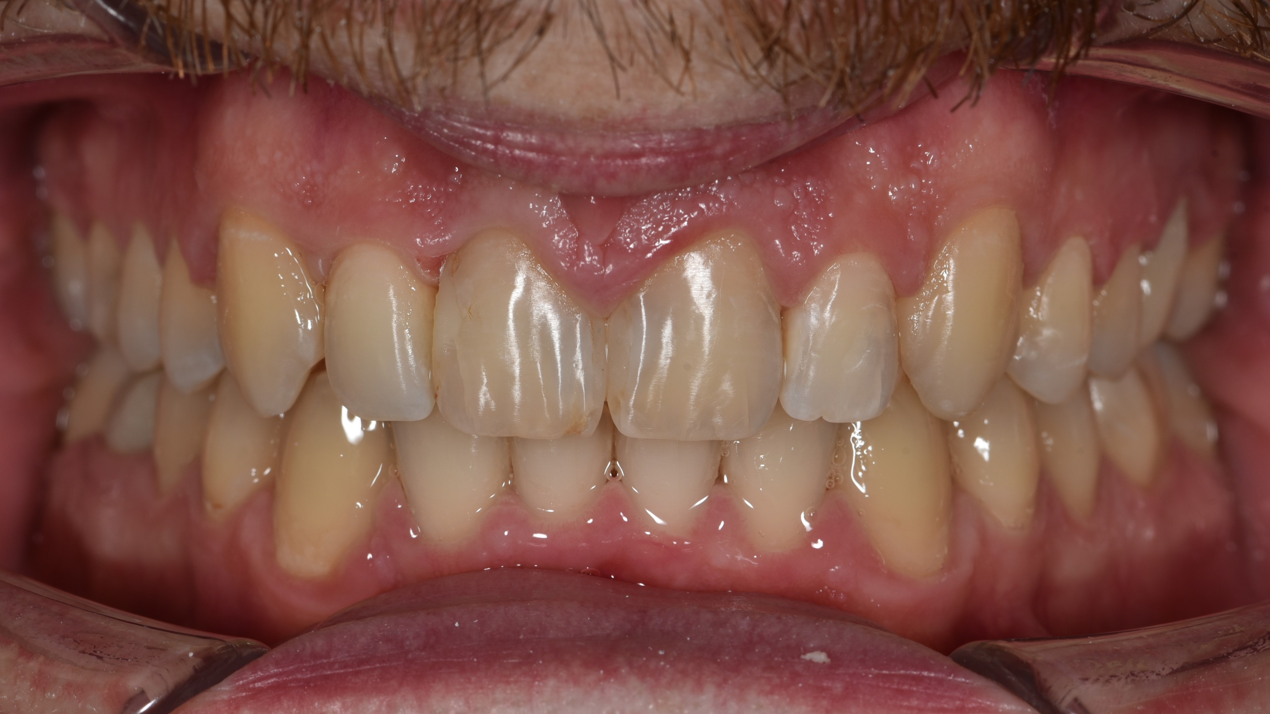 Лечение дистального глубокого прикуса.Брекеты Damon Q + минивинты. Срок лечения 2 года Врач : Ушакова А.Г.