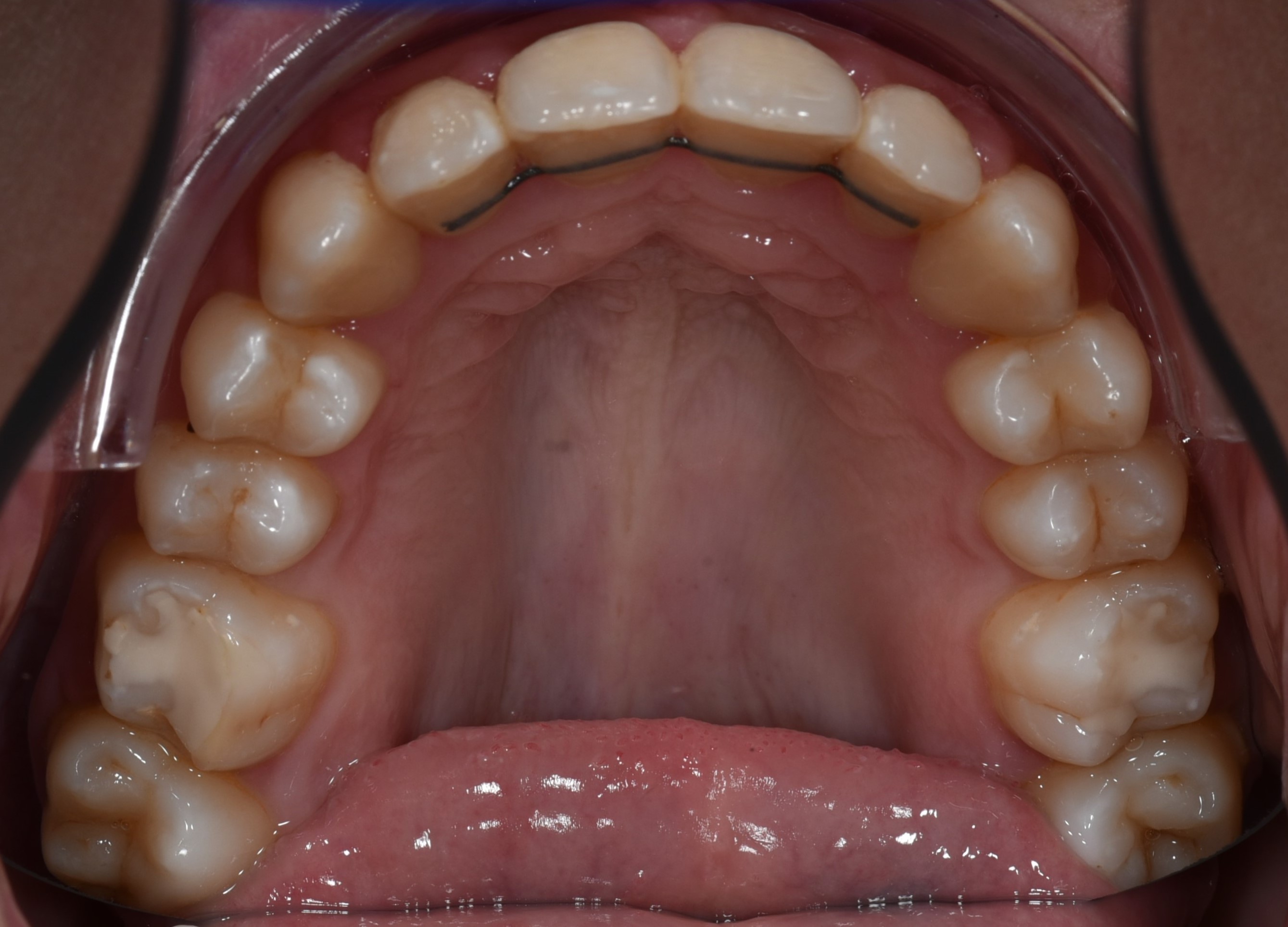 Лечение глубокого прикуса и скученного положения зубов. Брекеты Damon Q.Срок лечения 2 года  Врач: Ушакова А.Г.