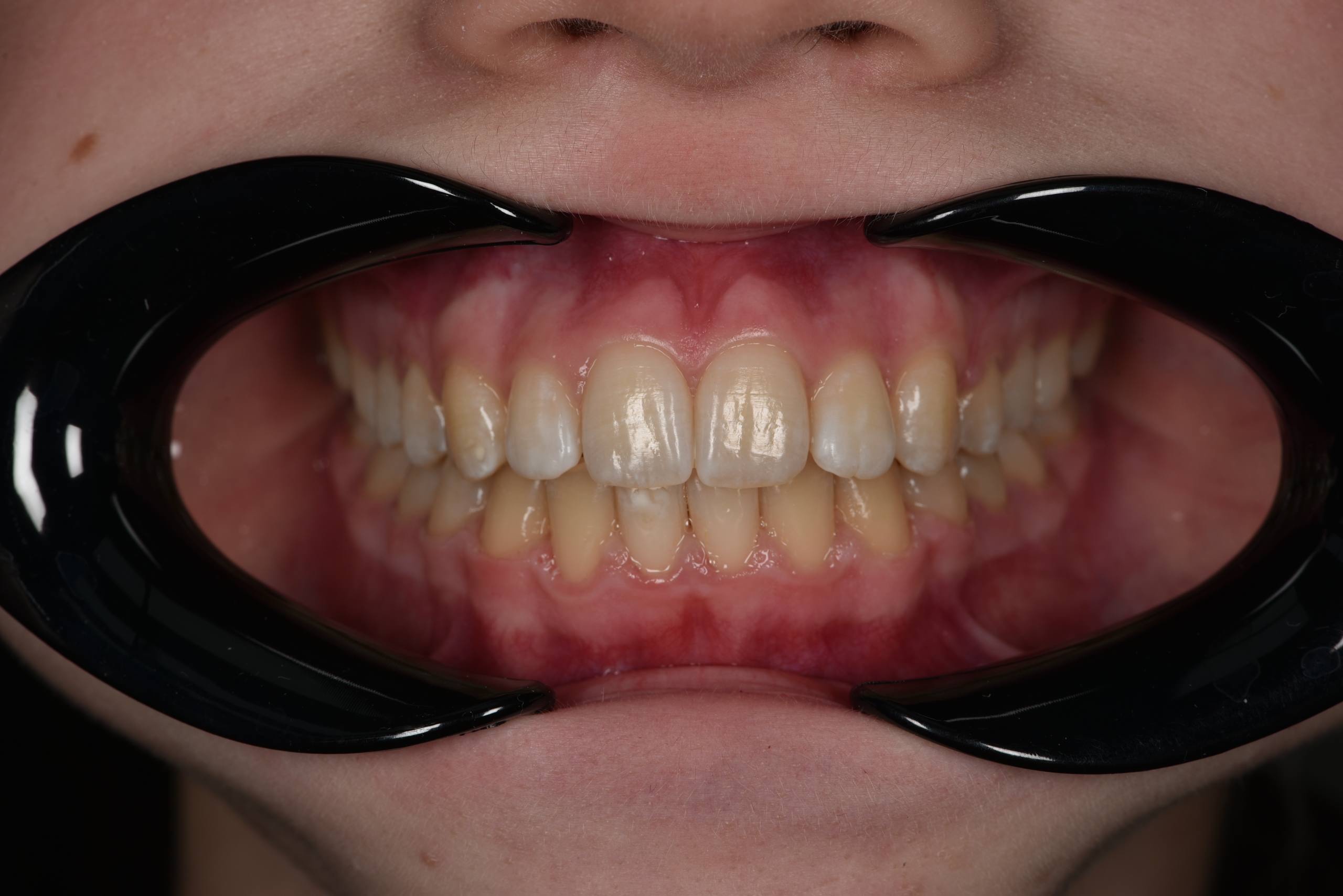 Коррекция скученности и перекрестного прикуса. Брекеты Damon. Врач: Ушакова А.Г.