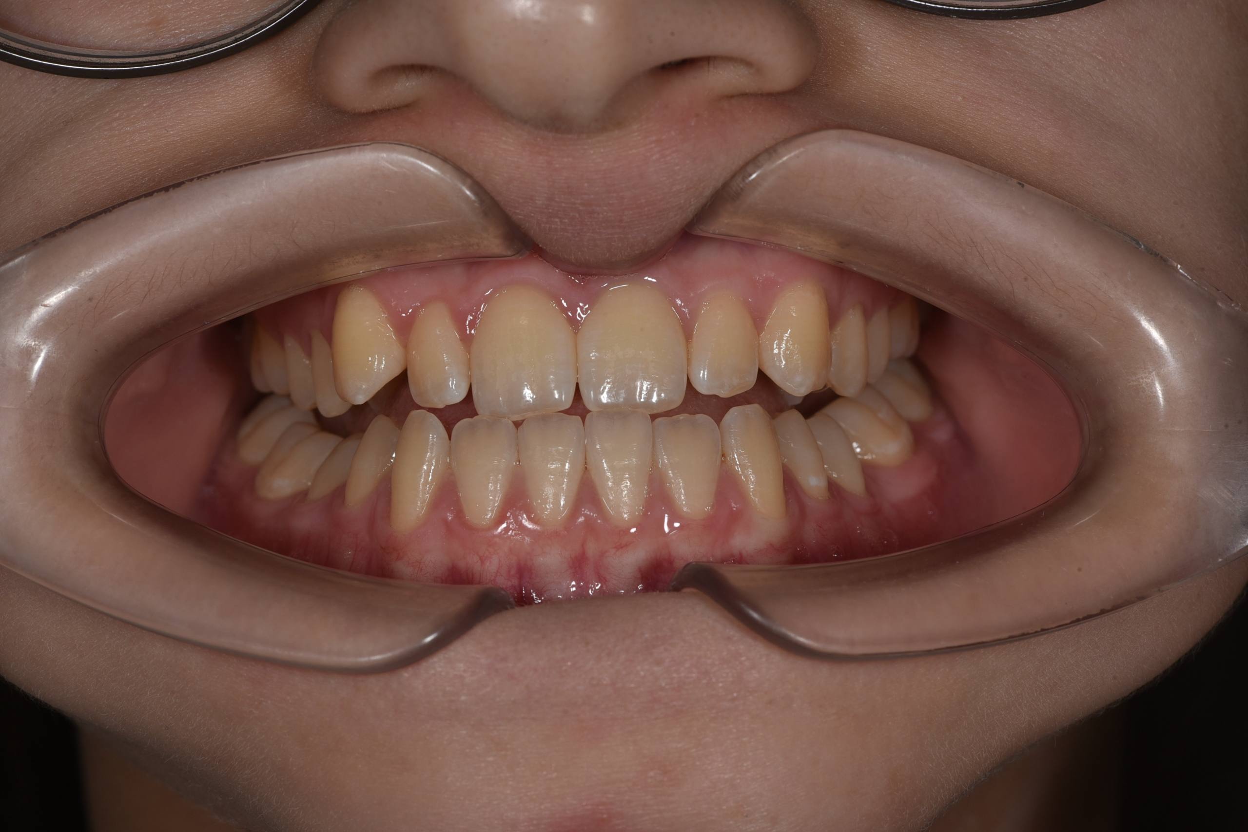 Коррекция мезиального прикуса. Брекеты Damon. Врач: Ушакова А.Г.