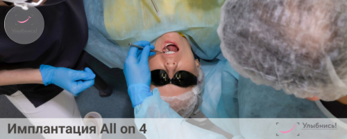 Имплантация All-on-4