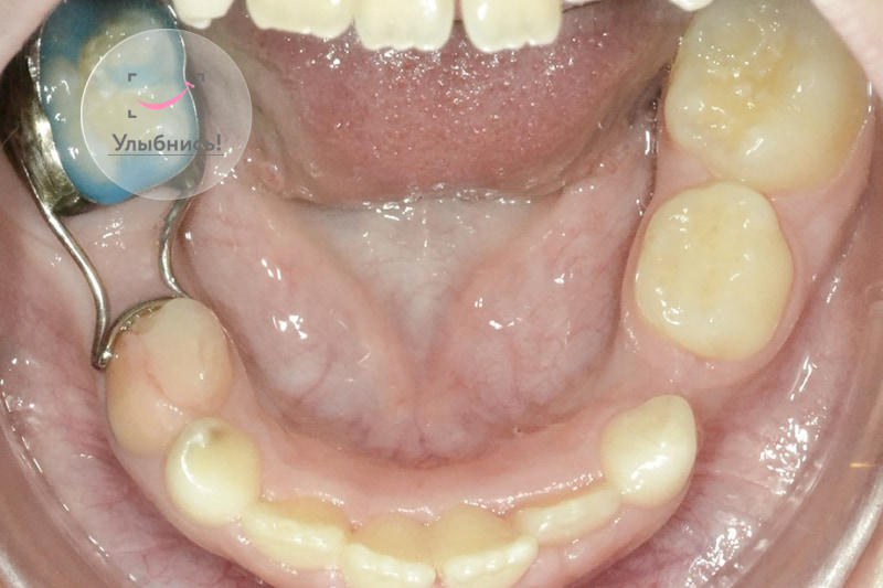 Удерживатель пространства (кольцо-петля)