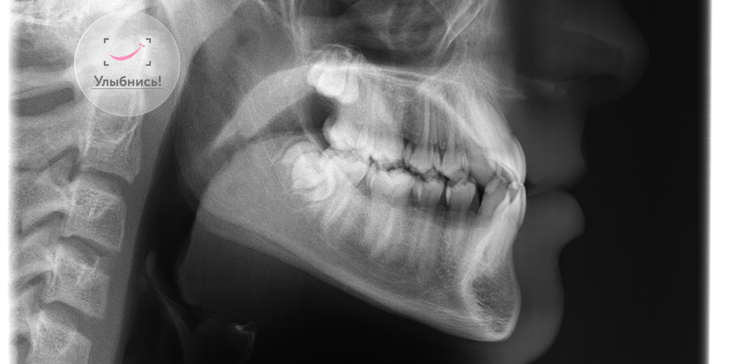Удаление зубов у подростков