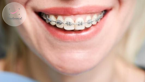 Брекеты