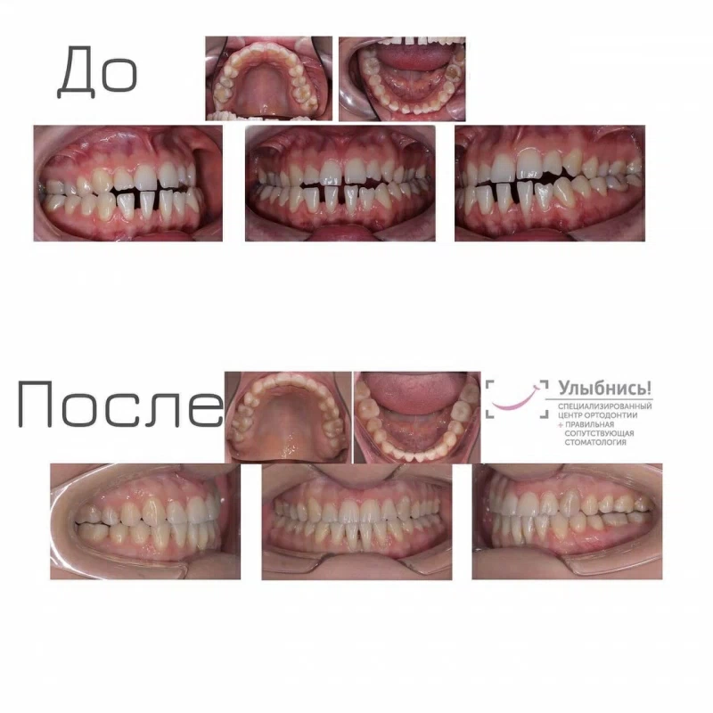 Ортогнатическая хирургия Ортогнатическая хирургия