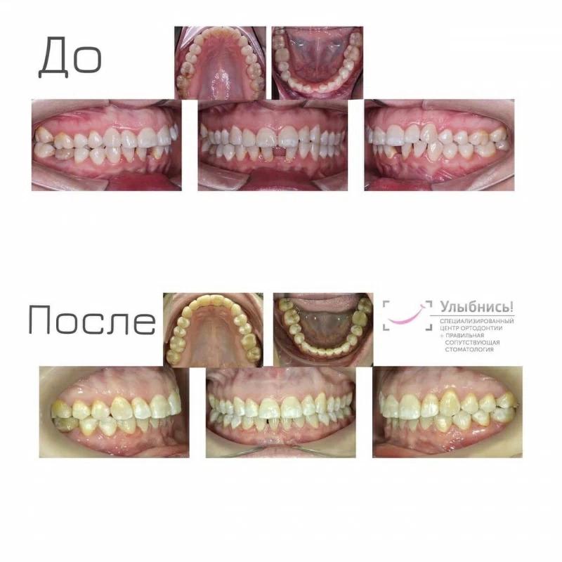 Ортогнатическая хирургия Ортогнатическая хирургия